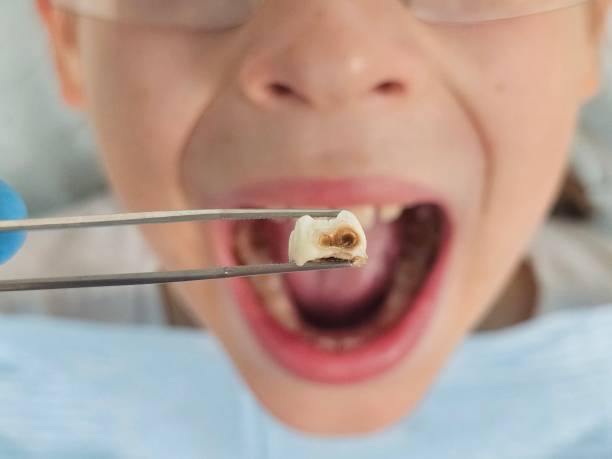 Best Emergency Tooth Extraction in Waldo, FL