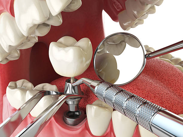 Best Emergency Broken Tooth Repair in Waldo, FL